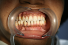 CEREC 1 A