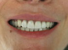 CEREC 6 B