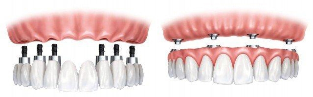 Implantsimage1